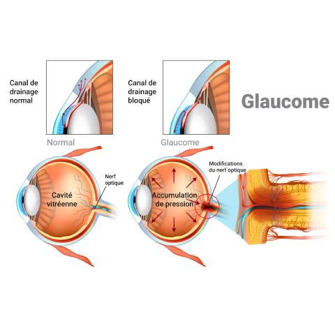 Illustration du glaucome chez le senior - Retraite Plus
